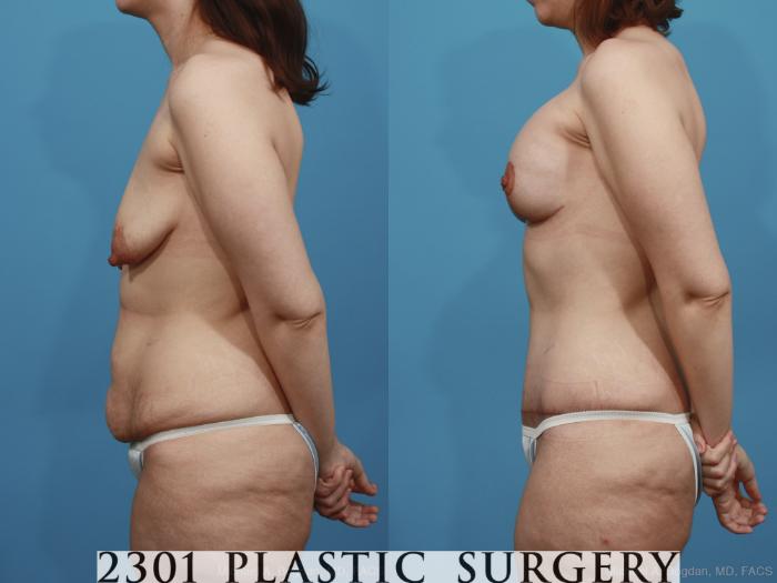Before & After Mastopexy & Augmentation Case 377 View #2 View in Fort Worth, Plano, & Frisco, Texas