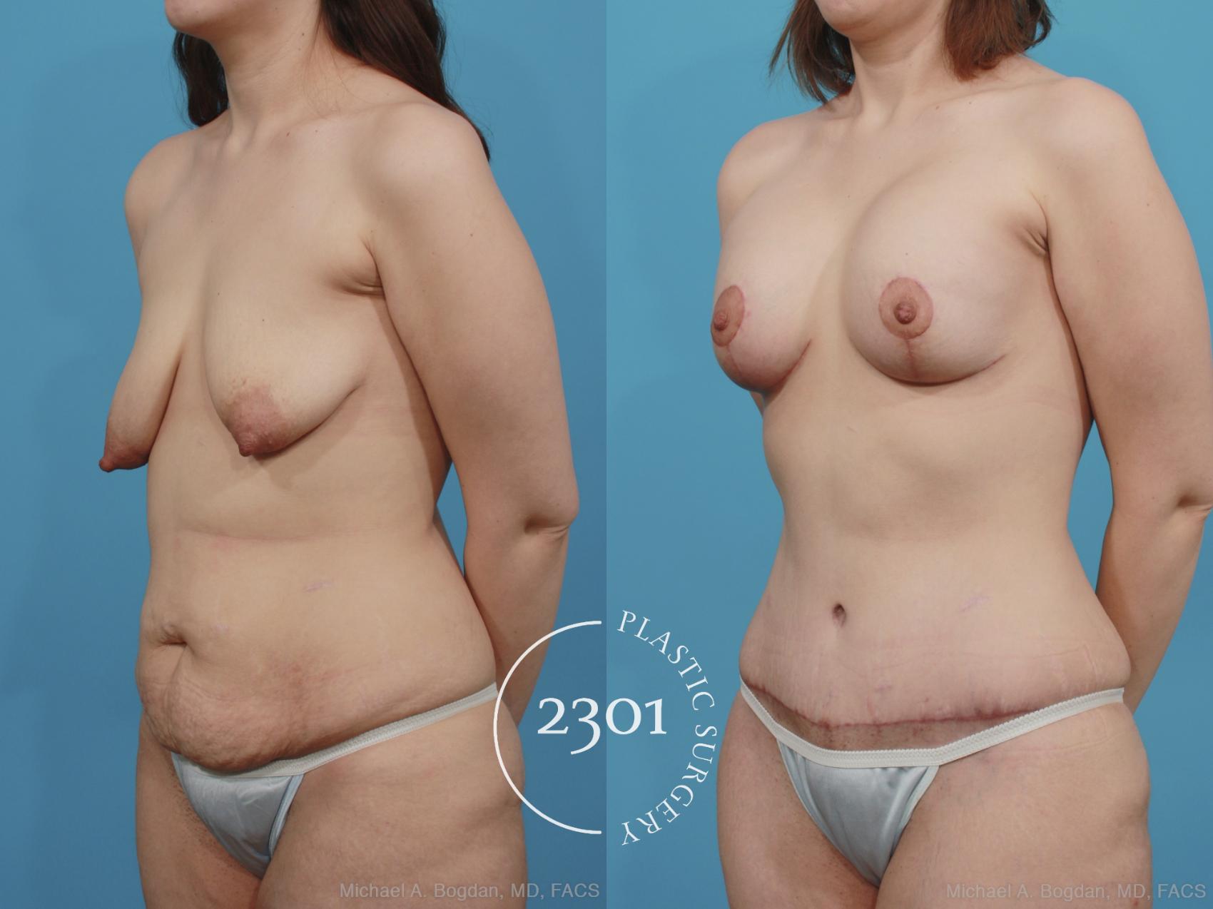 Before & After Mommy Makeover Case 377 View #3 View in Fort Worth, Plano, & Frisco, Texas