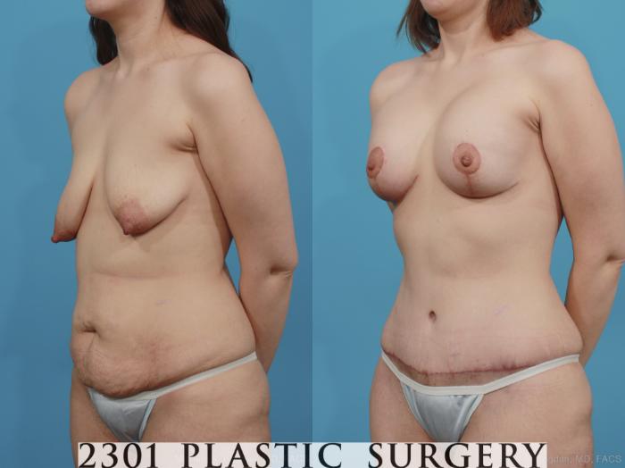 Before & After Mastopexy & Augmentation Case 377 View #3 View in Fort Worth, Plano, & Frisco, Texas