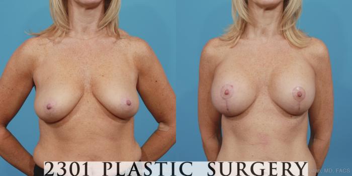 Before & After Mastopexy & Augmentation Case 389 View #1 View in Fort Worth, Plano, & Frisco, Texas
