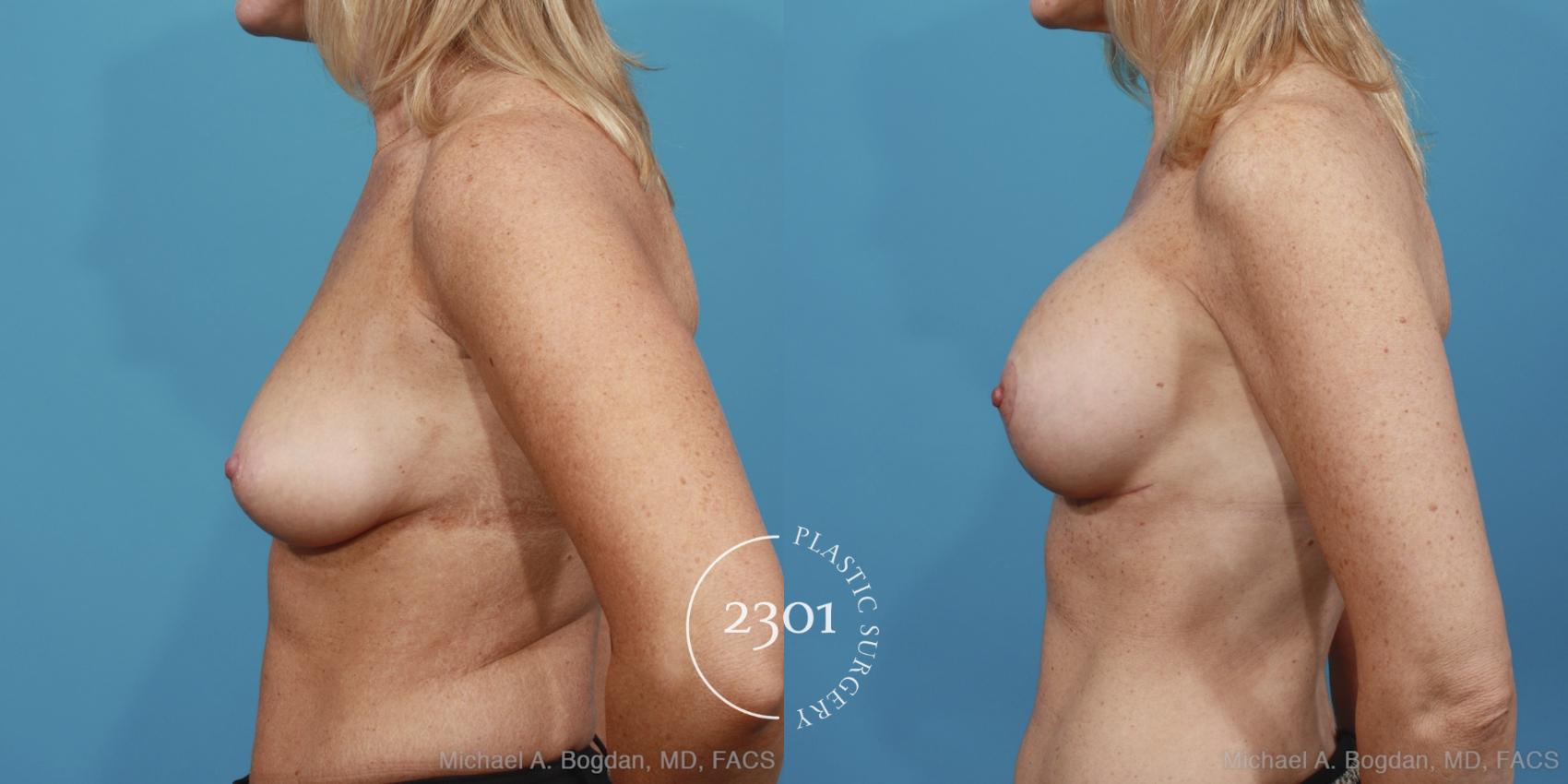 Before & After Silicone Implants Case 389 View #2 View in Fort Worth, Plano, & Frisco, Texas