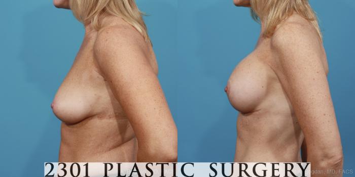Before & After Mastopexy & Augmentation Case 389 View #2 View in Fort Worth, Plano, & Frisco, Texas