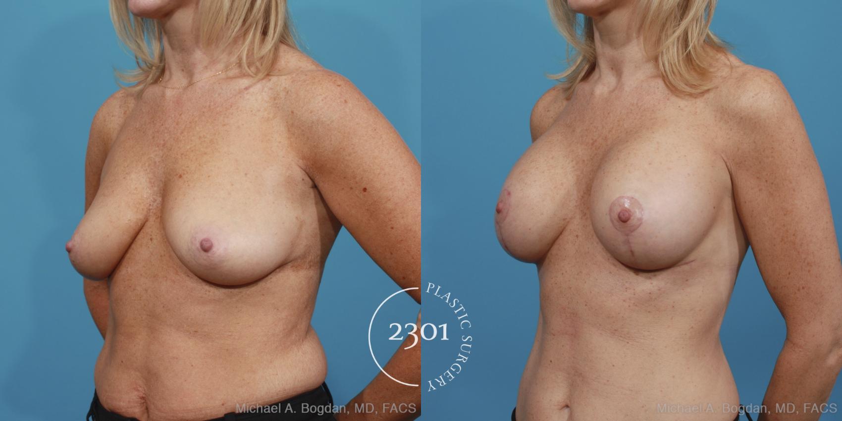 Before & After Silicone Implants Case 389 View #3 View in Fort Worth, Plano, & Frisco, Texas