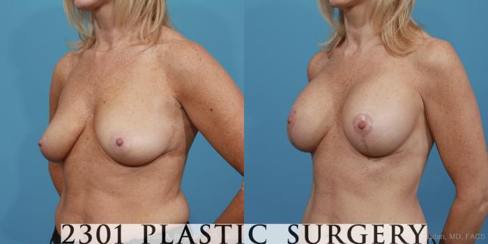 Before & After Mastopexy & Augmentation Case 389 View #3 View in Fort Worth, Plano, & Frisco, Texas