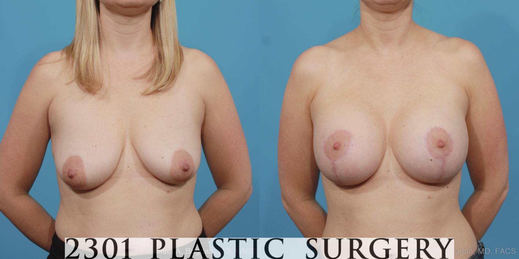 Before & After Mastopexy & Augmentation Case 404 View #1 View in Fort Worth, Plano, & Frisco, Texas