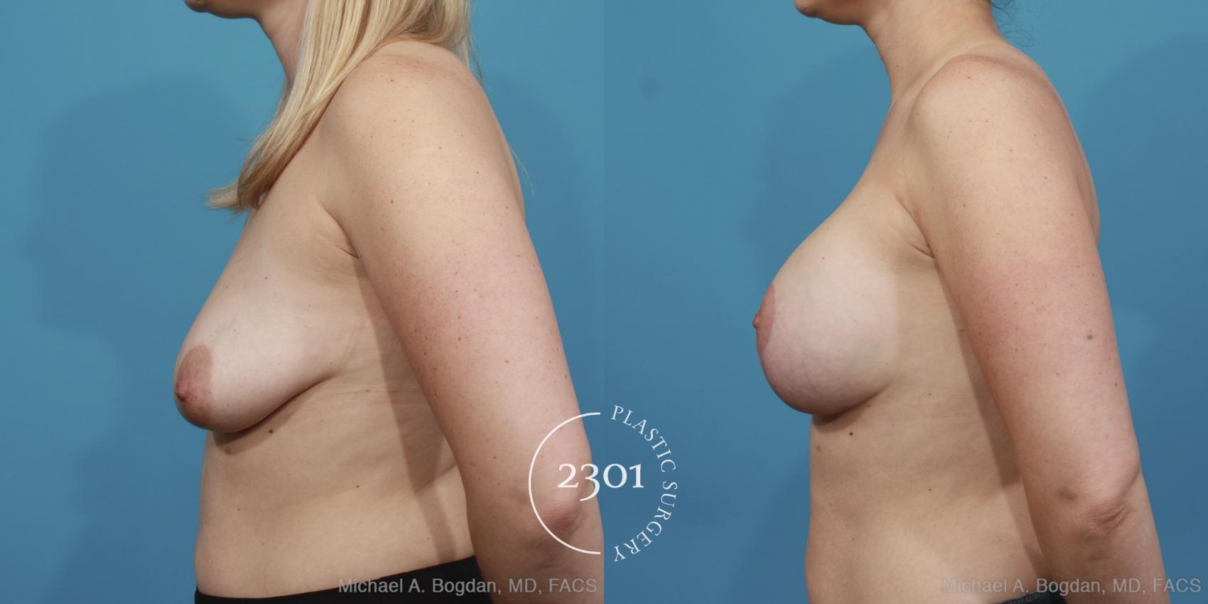 Before & After Mastopexy & Augmentation Case 404 View #2 View in Fort Worth, Plano, & Frisco, Texas