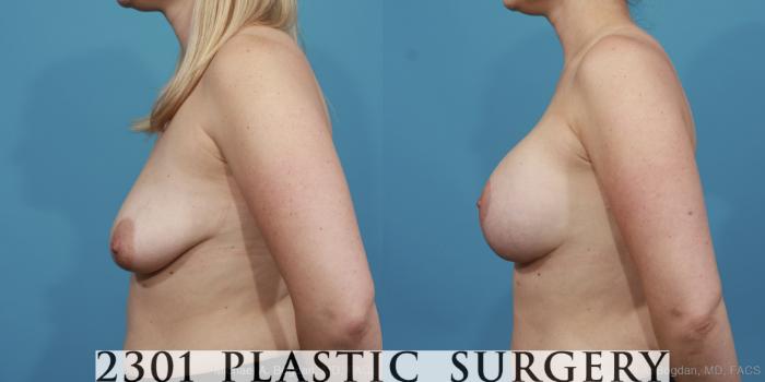 Before & After Mastopexy & Augmentation Case 404 View #2 View in Fort Worth, Plano, & Frisco, Texas