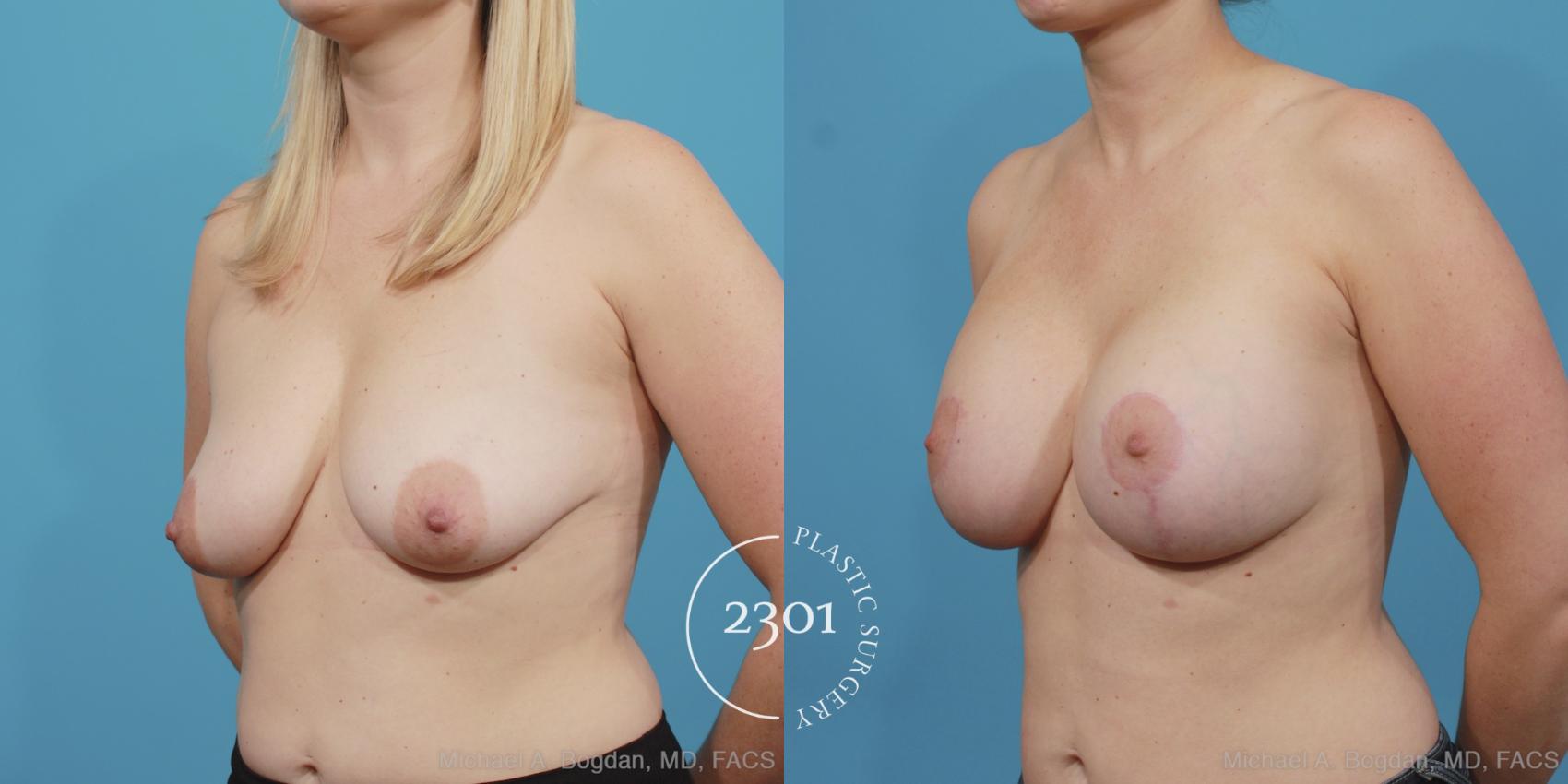 Before & After Mastopexy & Augmentation Case 404 View #3 View in Fort Worth, Plano, & Frisco, Texas