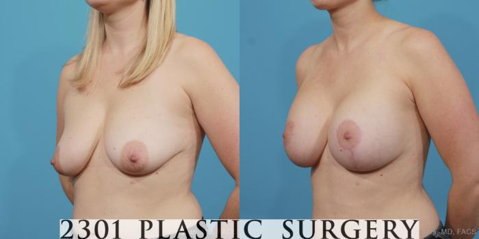 Before & After Mastopexy & Augmentation Case 404 View #3 View in Fort Worth, Plano, & Frisco, Texas