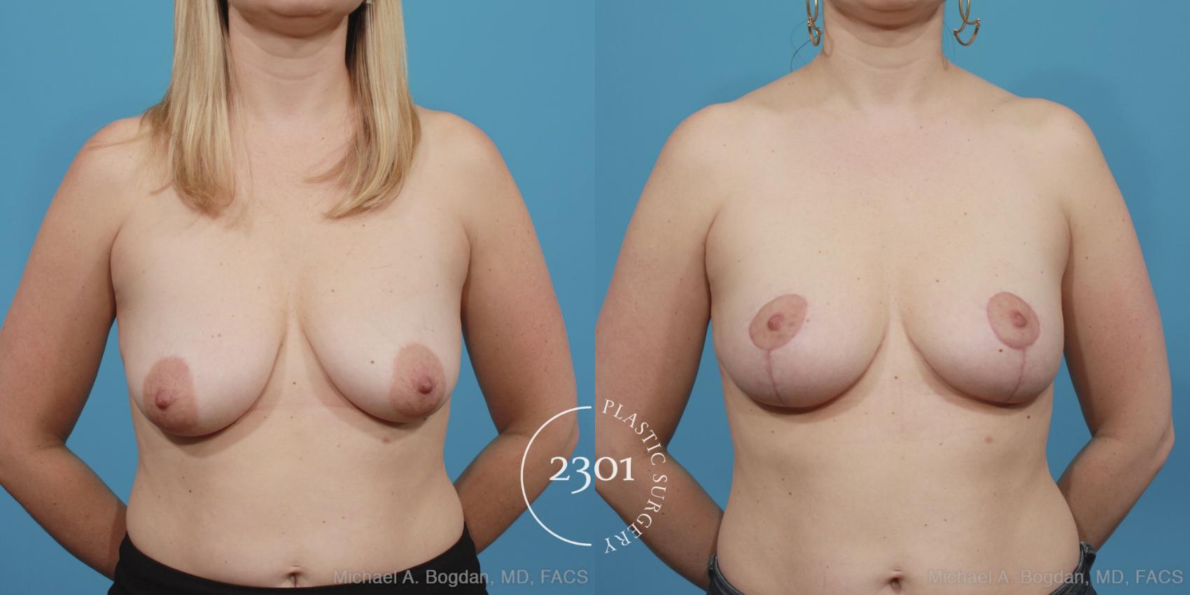 Before & After Mastopexy & Augmentation Case 404 View #4 View in Fort Worth, Plano, & Frisco, Texas