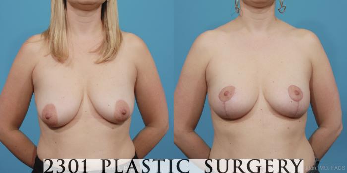 Before & After Mastopexy & Augmentation Case 404 View #4 View in Fort Worth, Plano, & Frisco, Texas