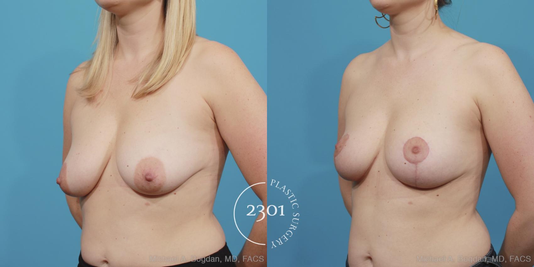 Before & After Mastopexy & Augmentation Case 404 View #5 View in Fort Worth, Plano, & Frisco, Texas
