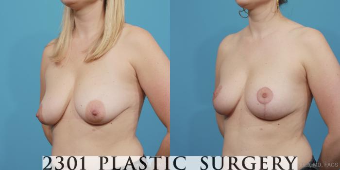 Before & After Mastopexy & Augmentation Case 404 View #5 View in Fort Worth, Plano, & Frisco, Texas