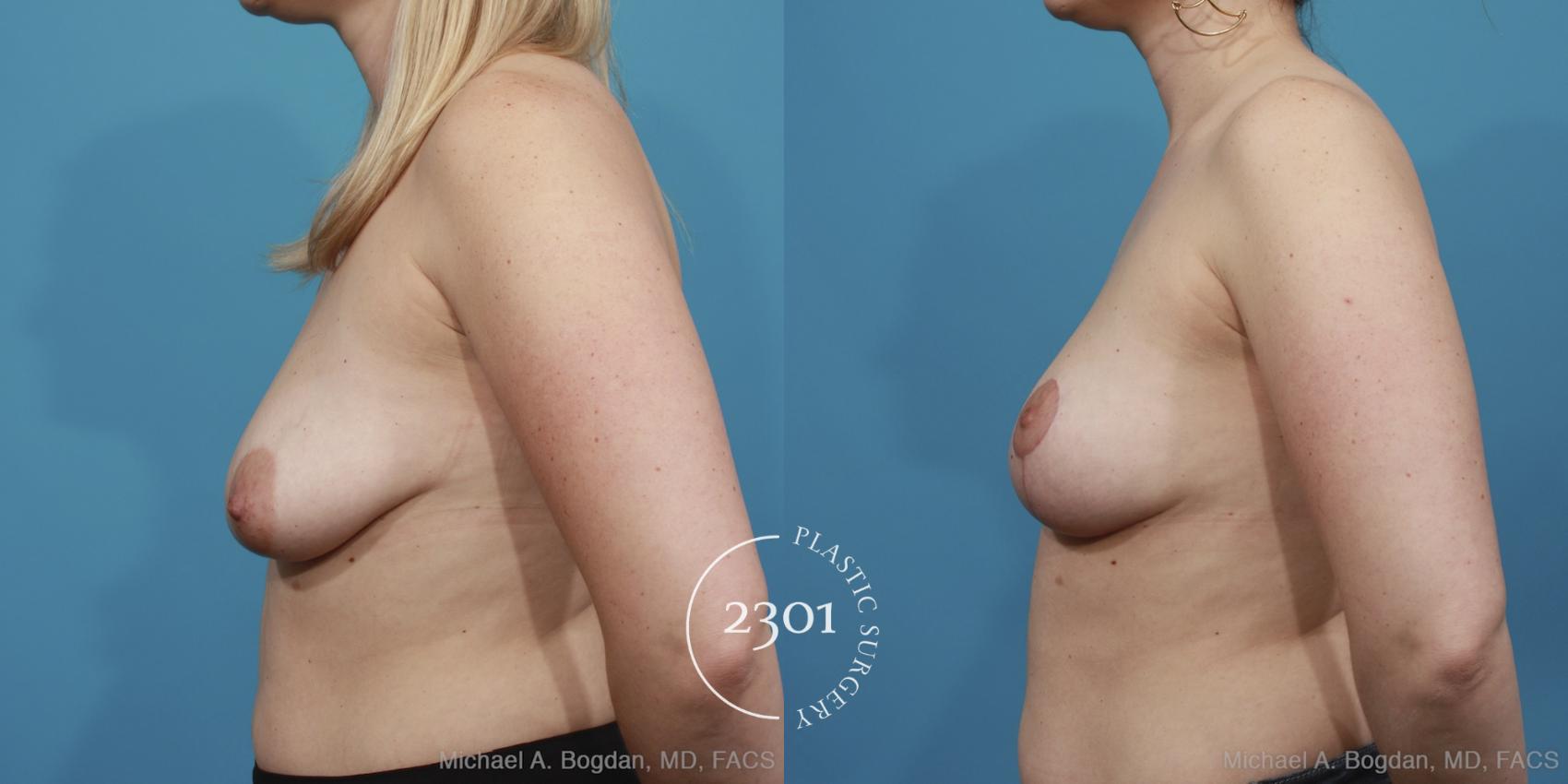 Before & After Mastopexy & Augmentation Case 404 View #6 View in Fort Worth, Plano, & Frisco, Texas