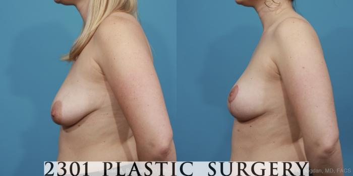 Before & After Mastopexy & Augmentation Case 404 View #6 View in Fort Worth, Plano, & Frisco, Texas