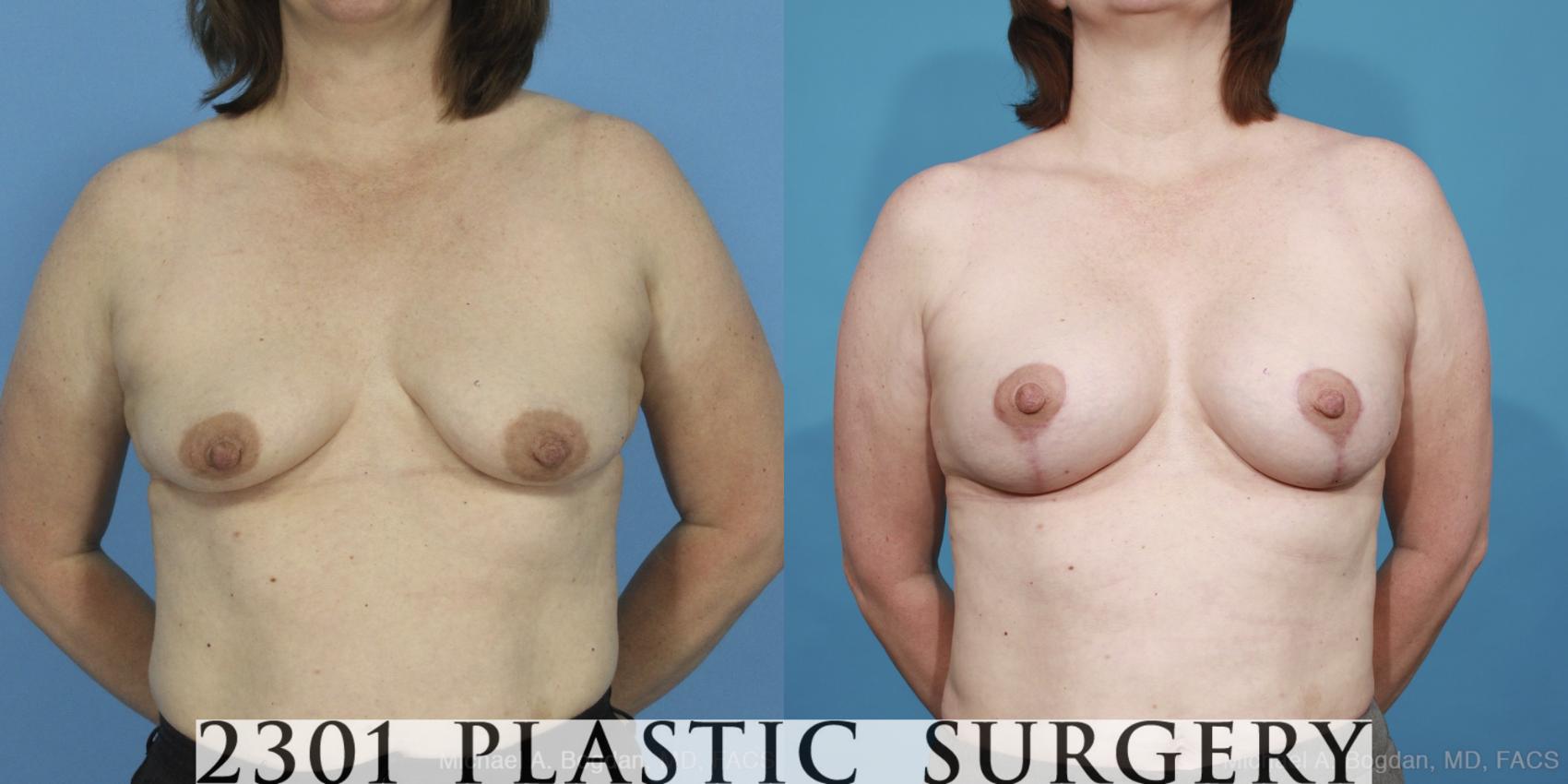 Before & After Mastopexy & Augmentation Case 424 View #1 View in Fort Worth, Plano, & Frisco, Texas
