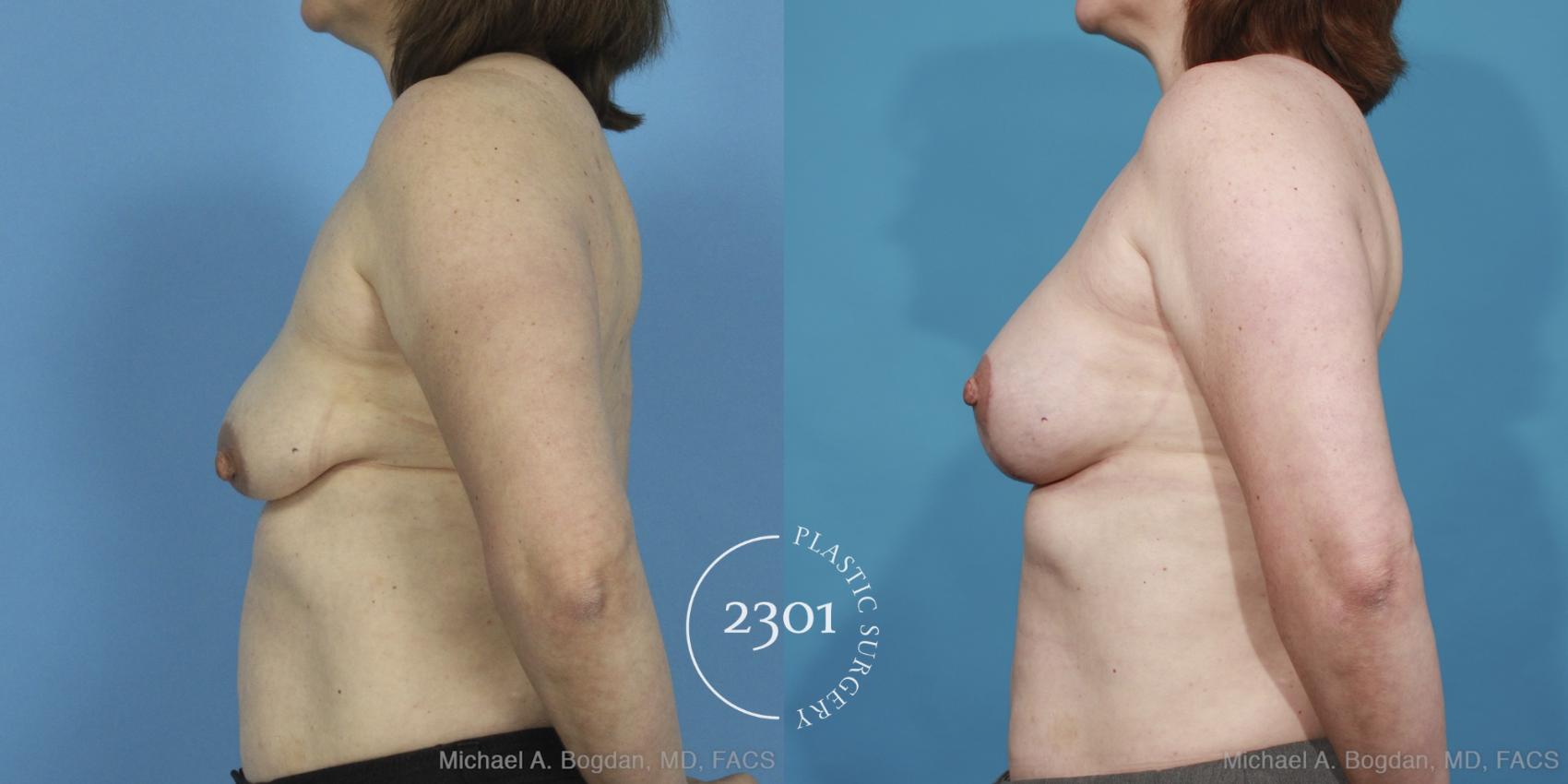 Before & After Mastopexy & Augmentation Case 424 View #2 View in Fort Worth, Plano, & Frisco, Texas