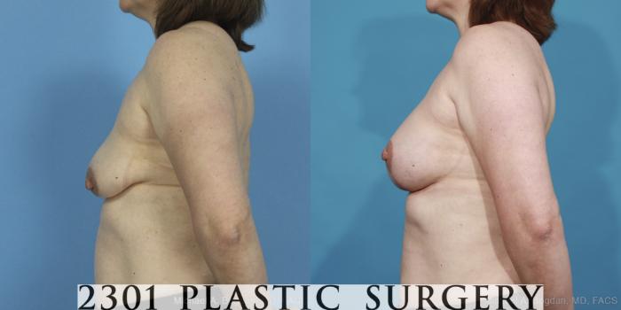 Before & After Mastopexy & Augmentation Case 424 View #2 View in Fort Worth, Plano, & Frisco, Texas
