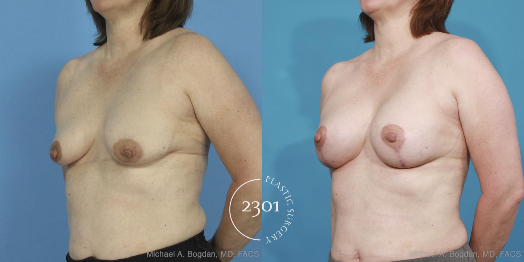 Before & After Mastopexy & Augmentation Case 424 View #3 View in Fort Worth, Plano, & Frisco, Texas