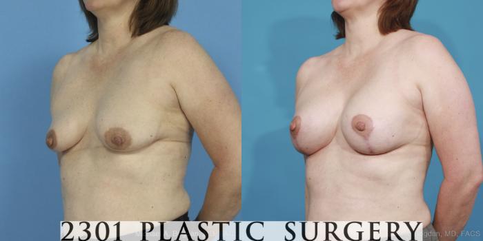 Before & After Mastopexy & Augmentation Case 424 View #3 View in Fort Worth, Plano, & Frisco, Texas