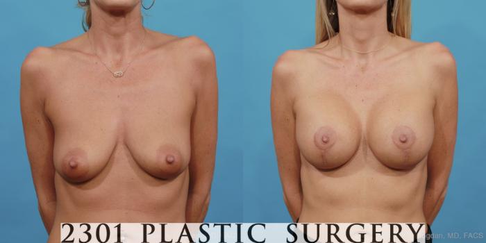 Before & After Mastopexy & Augmentation Case 442 View #1 View in Fort Worth, Plano, & Frisco, Texas