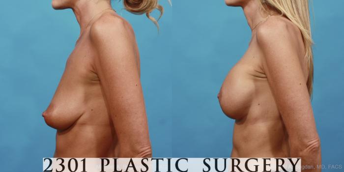 Before & After Mastopexy & Augmentation Case 442 View #2 View in Fort Worth, Plano, & Frisco, Texas