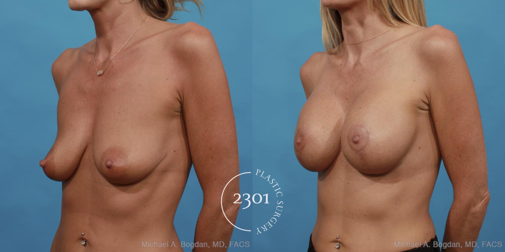 Before & After Mastopexy & Augmentation Case 442 View #3 View in Fort Worth, Plano, & Frisco, Texas