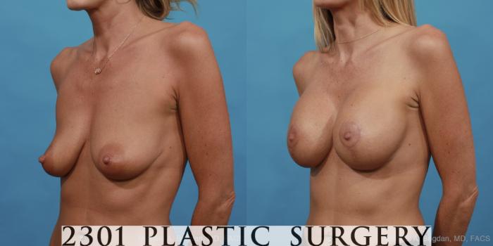 Before & After Mastopexy & Augmentation Case 442 View #3 View in Fort Worth, Plano, & Frisco, Texas
