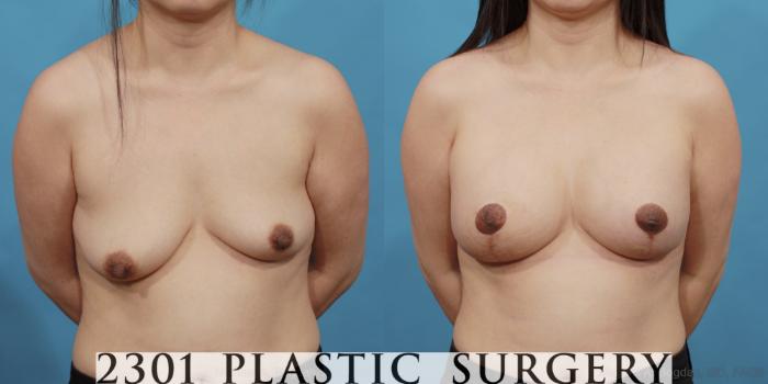 Before & After Silicone Implants Case 537 View #1 View in Fort Worth, Plano, & Frisco, Texas