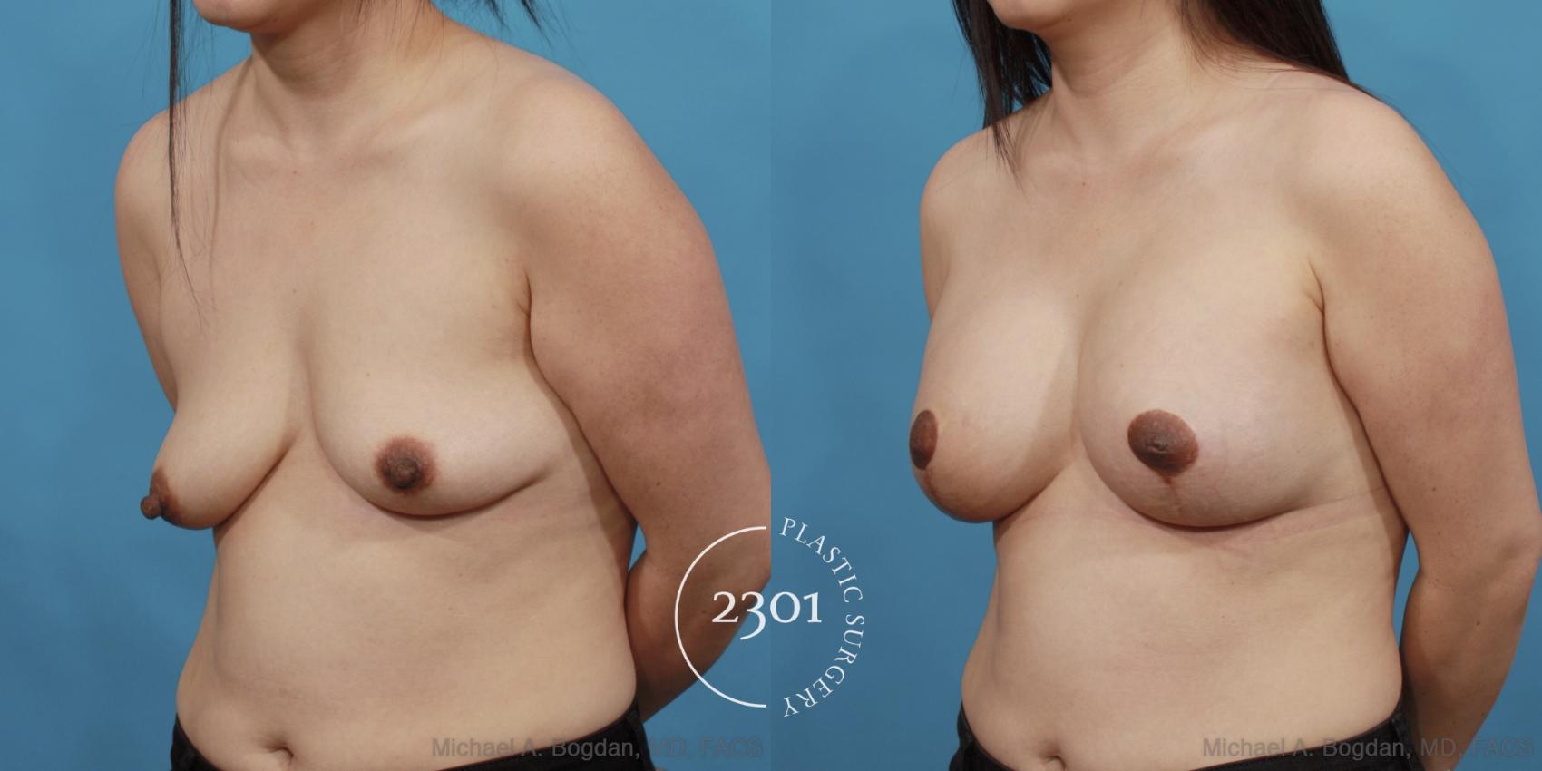 Before & After Mastopexy & Augmentation Case 537 View #2 View in Fort Worth, Plano, & Frisco, Texas