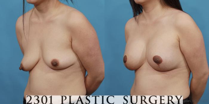 Before & After Mastopexy & Augmentation Case 537 View #2 View in Fort Worth, Plano, & Frisco, Texas