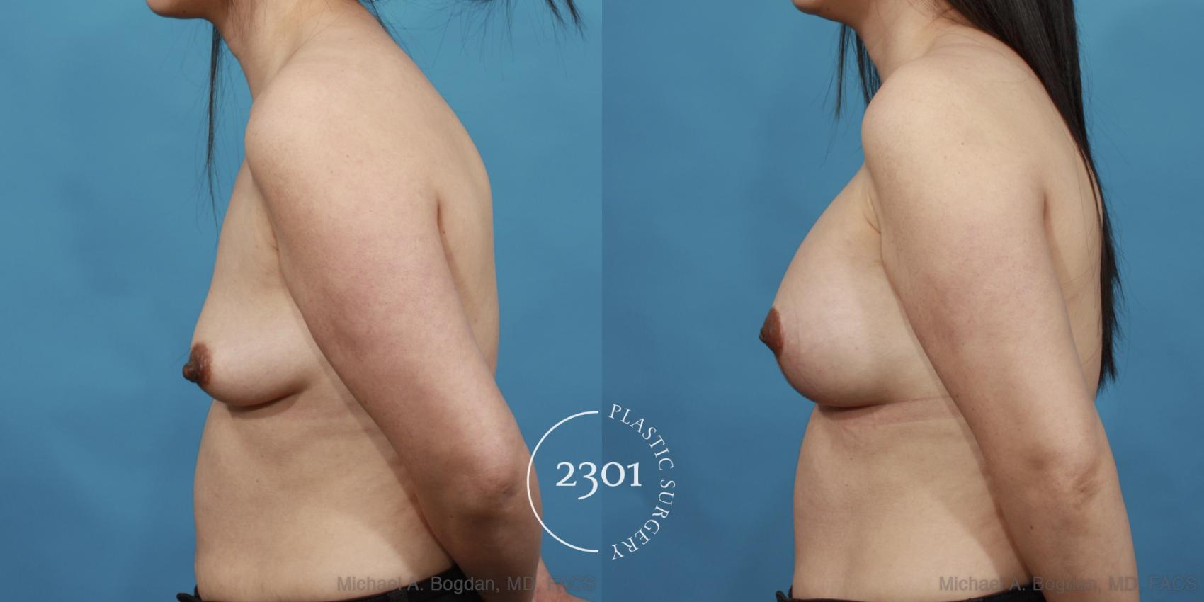Before & After Mastopexy & Augmentation Case 537 View #3 View in Fort Worth, Plano, & Frisco, Texas