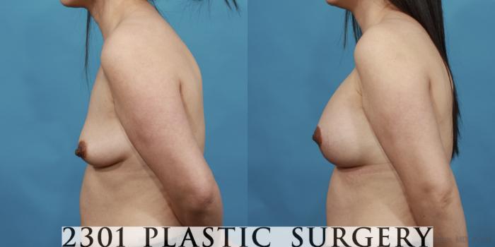 Before & After Mastopexy & Augmentation Case 537 View #3 View in Fort Worth, Plano, & Frisco, Texas