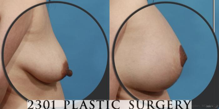 Before & After Silicone Implants Case 537 View #4 View in Fort Worth, Plano, & Frisco, Texas