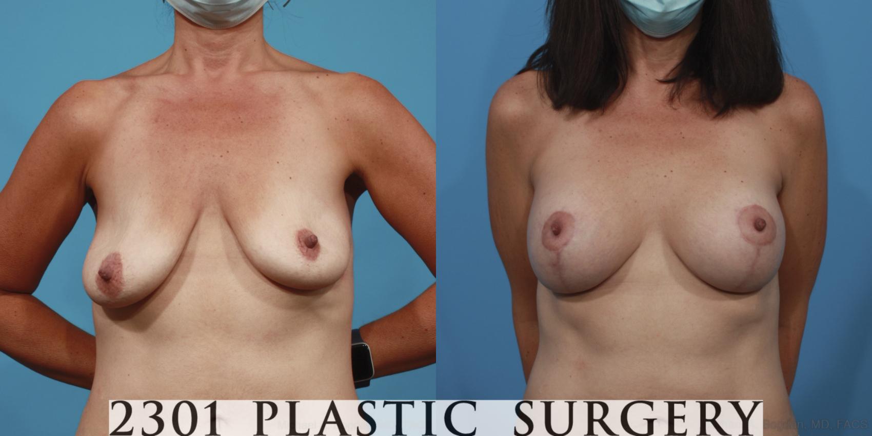 Before & After Mastopexy & Augmentation Case 639 Front View in Fort Worth & Frisco, Texas