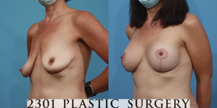 Before & After Breast Lift (Mastopexy) Case 639 Left Oblique View in Fort Worth, Plano, & Frisco, Texas