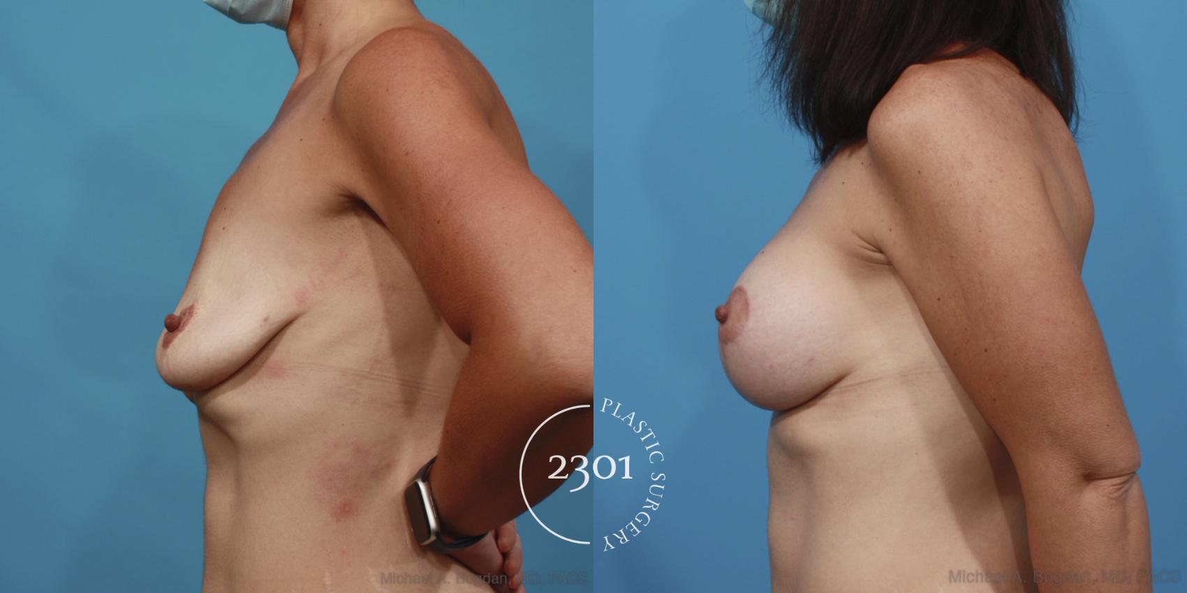 Before & After Silicone Implants Case 639 Left Side View in Fort Worth, Plano, & Frisco, Texas