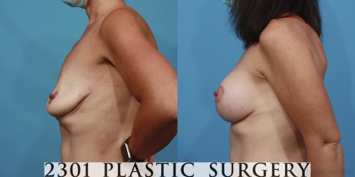 Before & After Silicone Implants Case 639 Left Side View in Fort Worth, Plano, & Frisco, Texas
