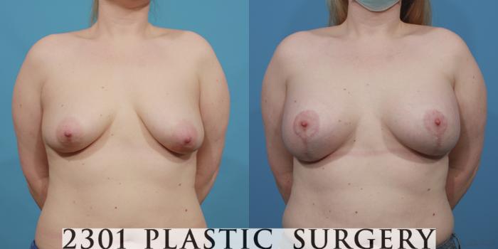 Before & After Silicone Implants Case 640 Front View in Fort Worth, Plano, & Frisco, Texas
