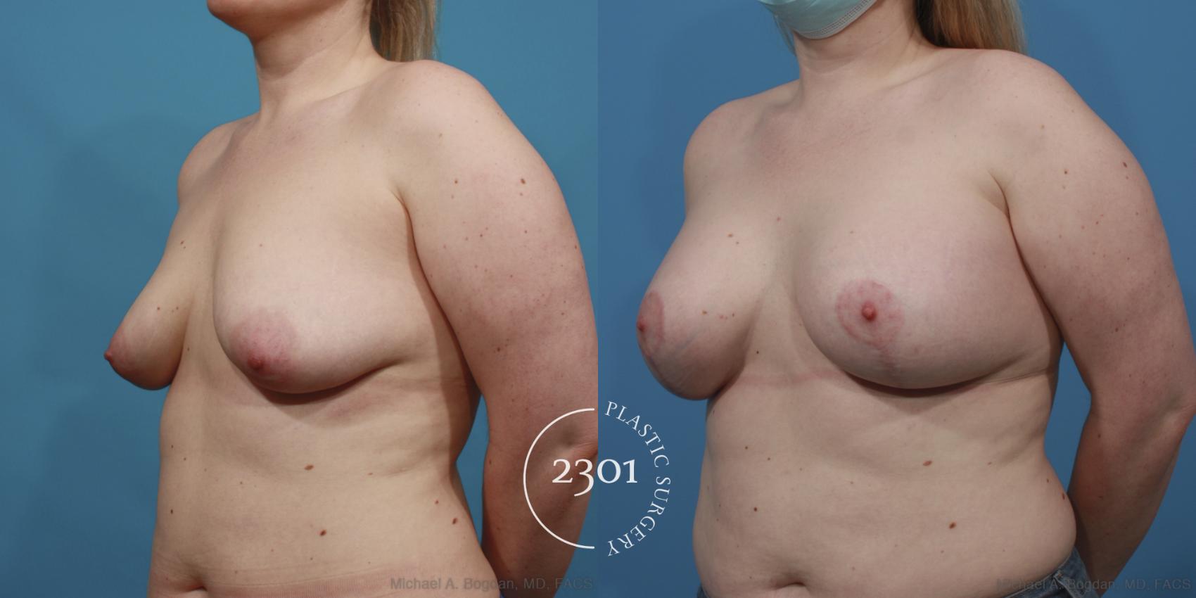 Before & After Silicone Implants Case 640 Left Oblique View in Fort Worth, Plano, & Frisco, Texas