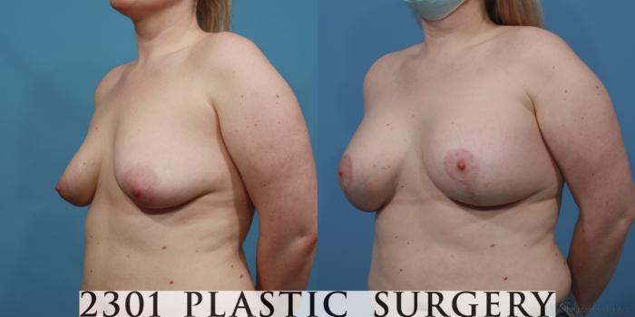 Before & After Breast Augmentation Case 640 Left Oblique View in Fort Worth, Plano, & Frisco, Texas