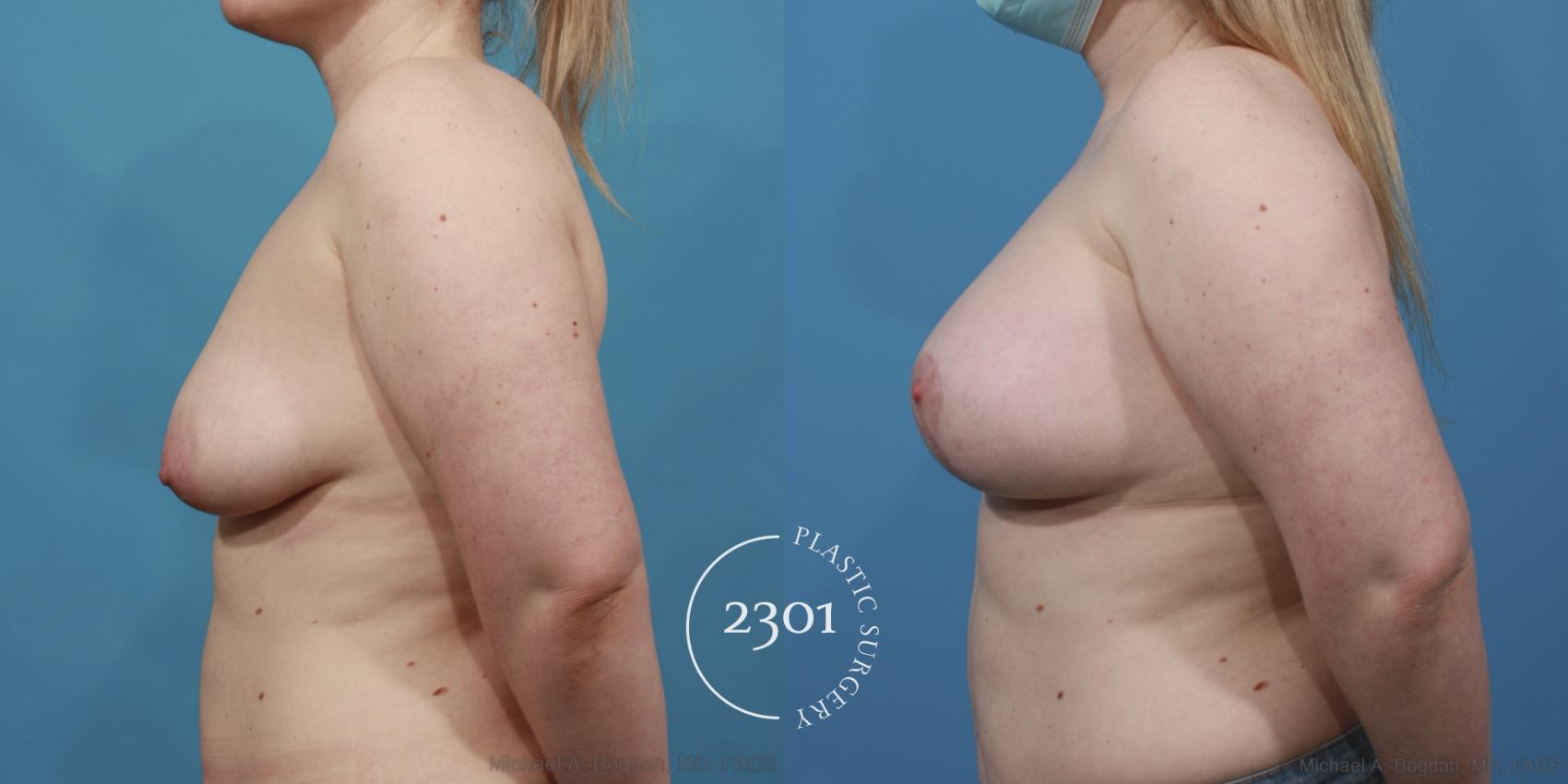 Before & After Silicone Implants Case 640 Left Side View in Fort Worth, Plano, & Frisco, Texas