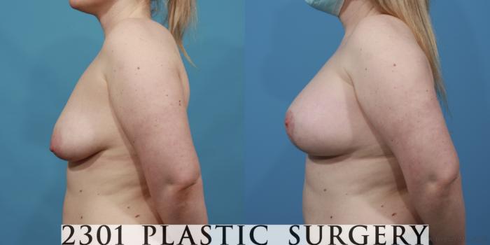 Before & After Silicone Implants Case 640 Left Side View in Fort Worth, Plano, & Frisco, Texas
