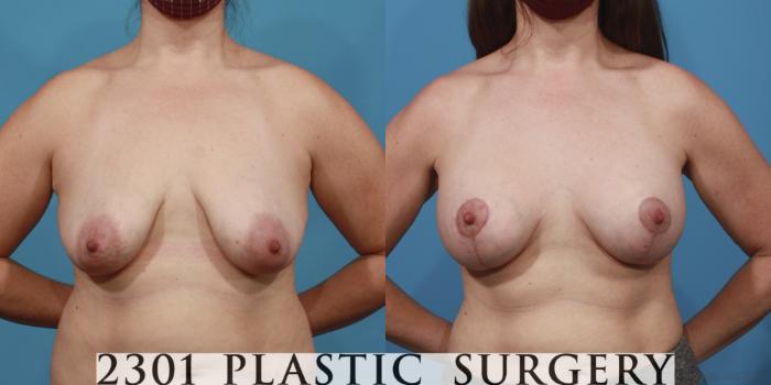 Before & After Silicone Implants Case 641 Front View in Fort Worth, Plano, & Frisco, Texas