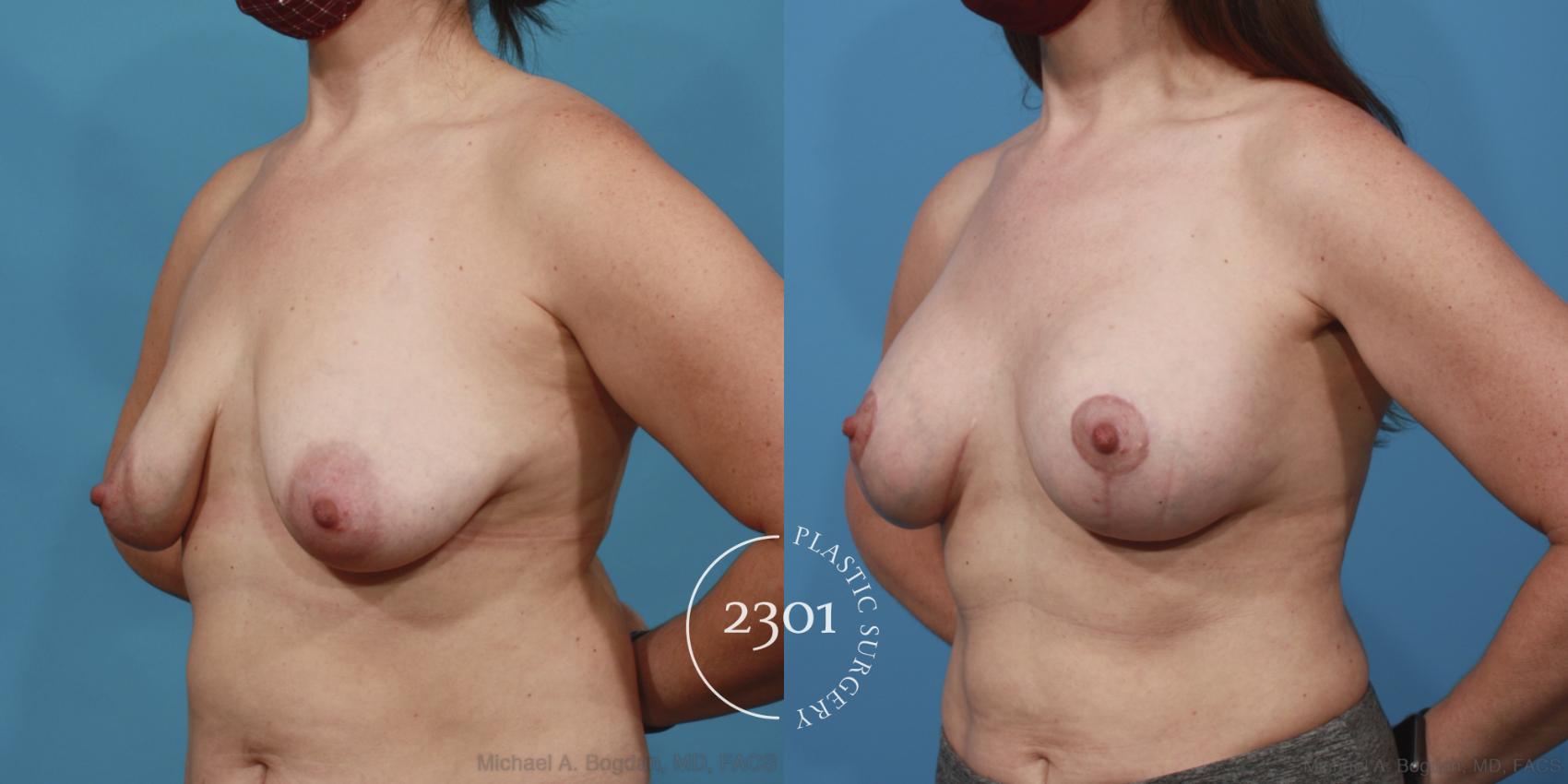 Before & After Silicone Implants Case 641 Left Oblique View in Fort Worth, Plano, & Frisco, Texas
