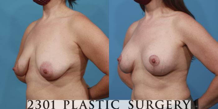 Before & After Breast Lift (Mastopexy) Case 641 Left Oblique View in Fort Worth, Plano, & Frisco, Texas