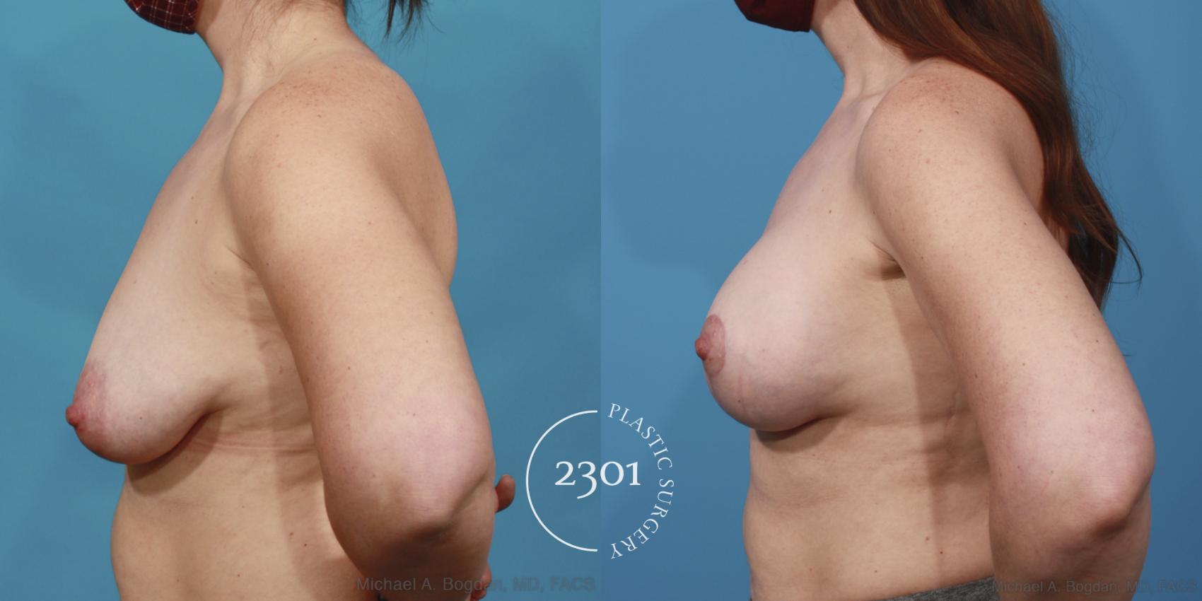 Before & After Silicone Implants Case 641 Left Side View in Fort Worth, Plano, & Frisco, Texas