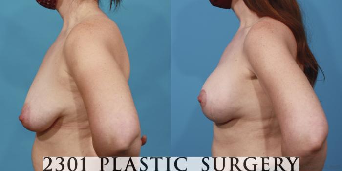 Before & After Breast Lift (Mastopexy) Case 641 Left Side View in Fort Worth, Plano, & Frisco, Texas
