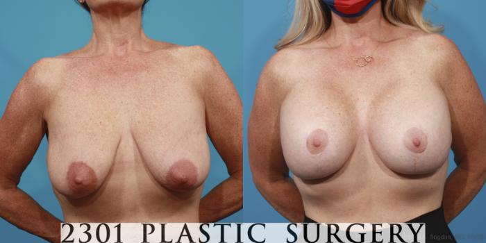 Before & After Silicone Implants Case 642 Front View in Fort Worth, Plano, & Frisco, Texas