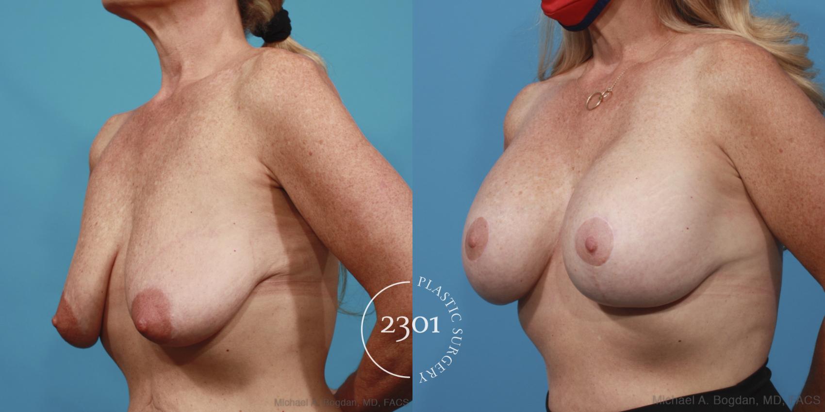 Before & After Silicone Implants Case 642 Left Oblique View in Fort Worth, Plano, & Frisco, Texas